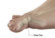 Common Toe Deformities