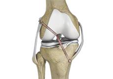 Knee Reconstruction
